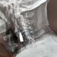 Radiografía que muestra la bala que ha vivido en el cuello de Zhao la mayor parte de su vida